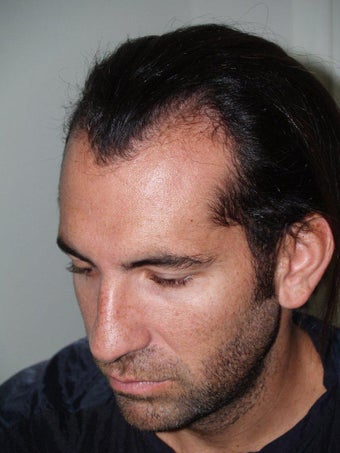 Hair Transplant and Rhinoplasty before 218116