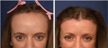 Hairline lowering before 130752