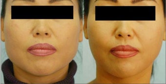 Botox Jaw Reduction before 136831