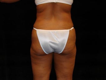 Buttocks Augmentation before 517579
