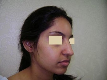 Rhinoplasty before 137959
