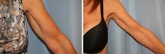 62 years old / brachioplasty, (arm lift) before 344019