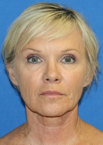 Facelift, Fat Transfer, and Skin Pinch before 398946