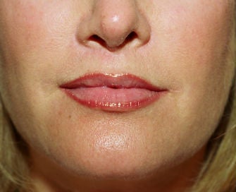 Lip lift, corner of lip lift, and filler in lips after 299913