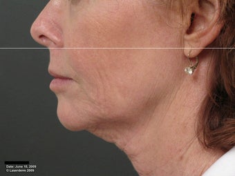 Ulthera Laser Skin Tightening before 346281