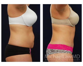 Abdominoplasty - Tummy Tuck 396148