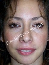 Chin Implants, Nose Surgery (Rhinoplasty) 622588