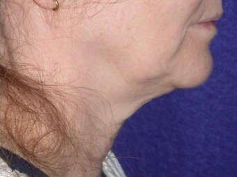 Necklift 208447