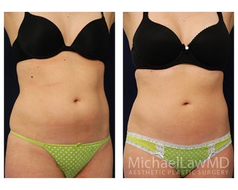 Liposuction 495007