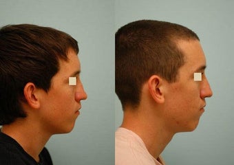 Revision/Corrective Rhinoplasty before 136571