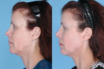 Ulthera Full Face and Neck before 378866