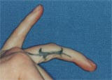 Tattoo Removal before 123389