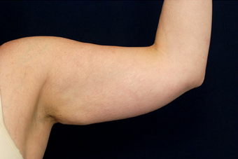 Liposuction - Upper Arms before 393164