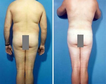 Liposuction before 636114