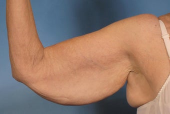 Arm Lift before 125541