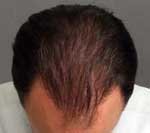 Hair Transplant after 426677