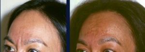 Forehead resection of the corrigator muscle before 209460