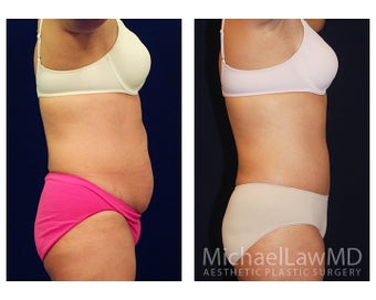 Tummy Tuck with Liposuction 391605