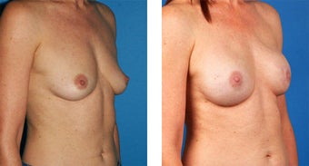 Breast Reconstruction: One-Stage Breast Reconstruction 561837