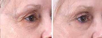 Botox for Frown Lines before 6323