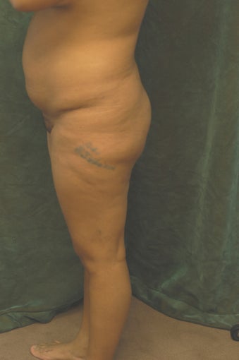 Women's Buttocks Augmentation before 518137