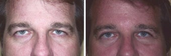 Botox Cosmetic before 378715