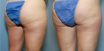 Cellulite Treatment Formula C9 641507