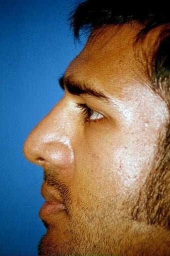 Rhinoplasty after 296744