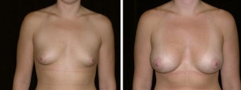26 year old female, breast augmentation before 628322