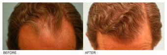 Hair Transplant before 134762