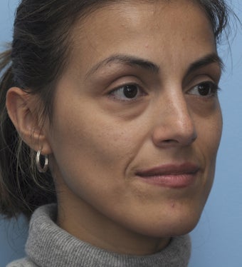Eye Dermafillers,Cheek Dermafillers,Facial Dermafillers 454584