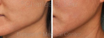 Jaw before 431363