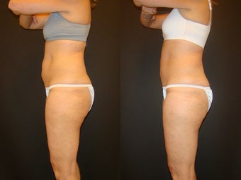 CoolSculpting before 576268