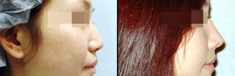 Rhinoplasty before 650820