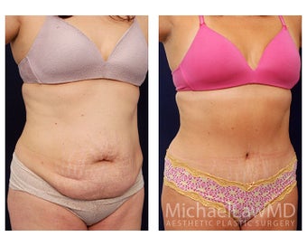 Abdominoplasty - Tummy Tuck after 396126