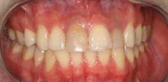 Anterior all ceramic crowns 559113