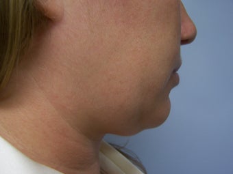 Liposuction to chin/neck area before 590814