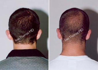 Ear Surgery - Otoplasty before 243389