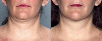 Liposuction of the Neck before 333084