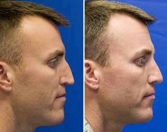 Revision Rhinoplasty with Rib cartilage graft after 295353