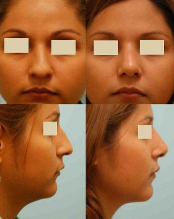 Revision/Corrective Rhinoplasty before 136564