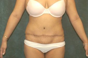 Women's Tummy Tuck Revision before 558745