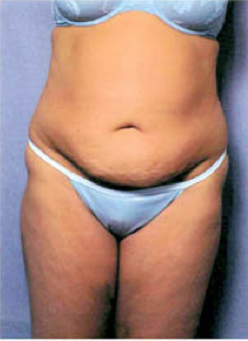 Tummy Tuck before 428194