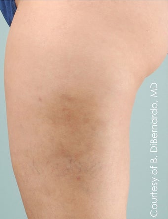 Smart Lipo after 606719