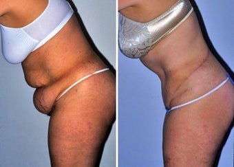 Abdominoplasty (Tummy tuck) after 330697