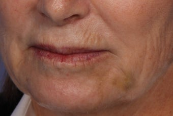 Botox and Juvederm 309243
