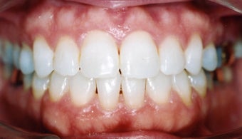 Orthodontic braces with miniscrew support to close openbite after 404689