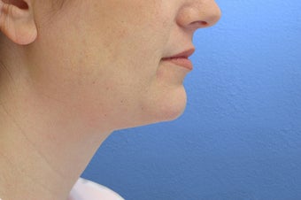 Neck Lift after 114169