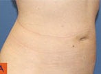 Smart Lipo after 606728