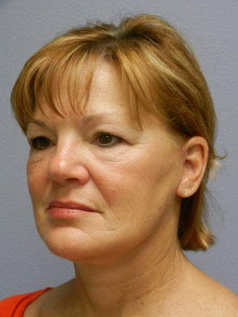 Lower Face with Neck Lift 574623